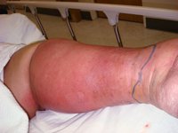 infectious_disease_and_mrsa57360.jpg