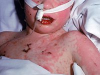 medication_adverse_events21793.jpg