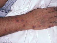 immunocompromised_associated_disease79985.jpg