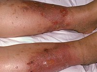 cellulitis_and_soft_tissue_infections1698.jpg