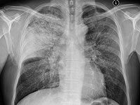pulmonary_infections46171.jpg