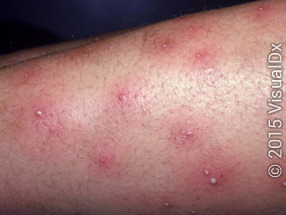 Overview of Bacterial Skin Infections - Skin Disorders ...