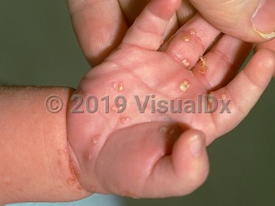 Clinical image of Congenital candidiasis - imageId=120247. Click to open in gallery.  caption: 'Numerous pustules on the palm and fingers, a crust on the middle digit, and papules and crusting at the wrist.'