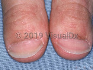 Clinical image of Hereditary brachyonychia - imageId=1645068. Click to open in gallery.  caption: 'Racquet nails of the thumbs.'