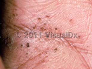 Clinical image of Porokeratotic eccrine ostial and dermal duct nevus - imageId=2036788. Click to open in gallery.  caption: 'Numerous keratotic pits of various sizes, some with a brown hue, on the palm.'