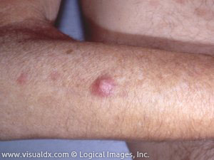 meningococcemia rashes #11