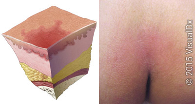 Where can you find pictures of the stages of bed sores?