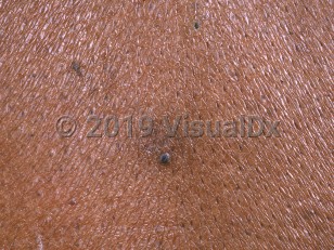 Clinical image of Epidermolytic acanthoma - imageId=1000448. Click to open in gallery.  caption: 'A close-up of a blackish scaly papule.'