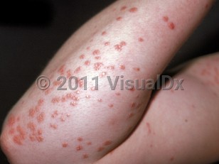 Clinical image of Eruptive xanthoma - imageId=100090. Click to open in gallery.  caption: 'Multiple smooth, yellowish, orange, and reddish papules on the arm.'