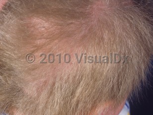 Clinical image of Congenital pili torti - imageId=1011008. Click to open in gallery.  caption: 'Unruly, brittle hair, shimmering in areas.'