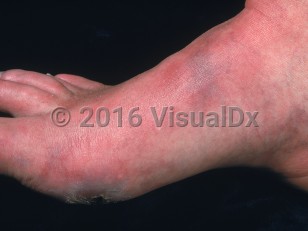 Clinical image of Peripheral arterial disease - imageId=1020685. Click to open in gallery.  caption: 'Dependent rubor (suffusion and erythema of the foot) in a patient with peripheral arterial disease.'