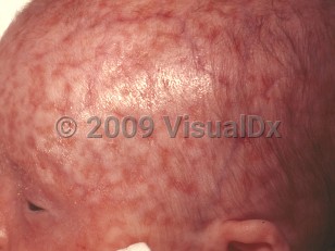 Clinical image of Neonatal lupus erythematosus - imageId=102924. Click to open in gallery.  caption: 'Confluent white papules, forming plaques that cover most of the scalp.'