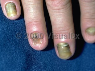 Clinical image of Yellow nail syndrome - imageId=103103. Click to open in gallery.  caption: 'Thickened yellow-green fingernails with increased longitudinal and transverse curvature. The index fingernail is shortened and the ring fingernail has been lost. Note also the nailfold erythema and edema of chronic paronychiae.'