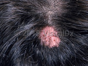 Clinical image of Syringocystadenoma papilliferum - imageId=1031548. Click to open in gallery.  caption: 'A frambesiform pink nodule on the scalp.'