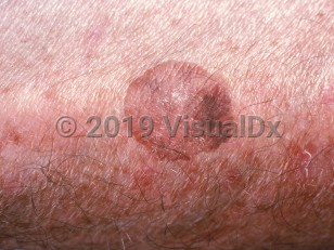 Clinical image of Large cell acanthoma - imageId=1033472. Click to open in gallery.  caption: 'A close-up of a variegated pink and brown stuck-on, wrinkled plaque.'