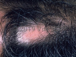 Clinical image of Traumatic alopecia - imageId=1034378. Click to open in gallery.  caption: 'A hairless scar on the scalp, secondary to forceps delivery 30 years prior. '