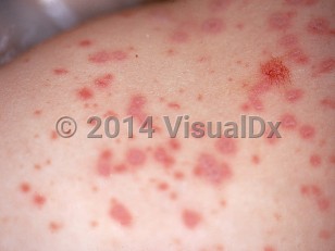 Clinical image of Vaccinia-induced erythema multiforme - imageId=1036141. Click to open in gallery.  caption: 'A close-up of erythematous papules, many targetoid.'