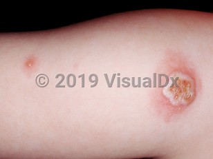 Clinical image of Accidental implantation vaccinia - imageId=1036991. Click to open in gallery.  caption: 'A crusted, cloudy bulla with a scalloped border and surrounding erythema, with a nearby vesicle atop an erythematous macule, on the upper arm.'
