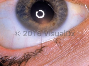 Clinical image of Vaccinia keratitis - imageId=1039372. Click to open in gallery. 