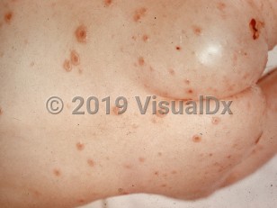 Clinical image of Generalized vaccinia