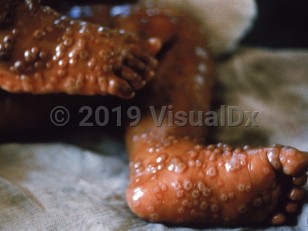 Clinical image of Smallpox - imageId=1040227. Click to open in gallery.  caption: 'Myriad large vesicles, some with central umbilication, on the legs and feet.'