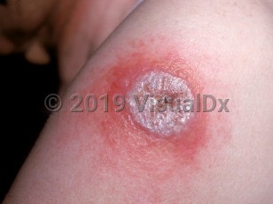 Clinical image of Progressive vaccinia - imageId=1042753. Click to open in gallery.  caption: 'A large purulent bulla with central crusting and surrounding erythema and edema on the upper arm.'