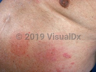 Clinical image of Systemic contact dermatitis
