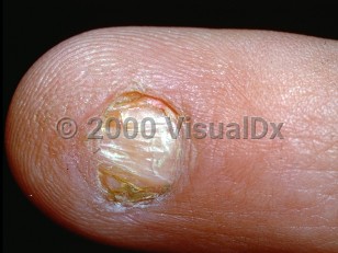 Clinical image of Nail-patella syndrome