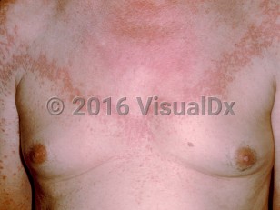 Clinical image of Generalized granuloma annulare - imageId=1073969. Click to open in gallery.  caption: 'Widespread smooth pink and brownish papules and plaques on the trunk and arm.'