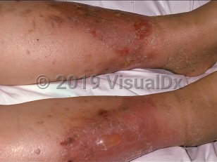 Clinical image of Stasis dermatitis - imageId=108674. Click to open in gallery.  caption: 'Large, scaly, and eroded erythematous plaques with overlying bulla formation on the shins.'