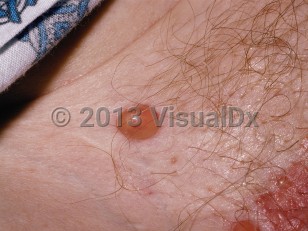 Clinical image of Bullous pemphigoid - imageId=108986. Click to open in gallery.  caption: 'A close-up of a tense bulla and a vesicle at the edge of a healing eroded plaque.'