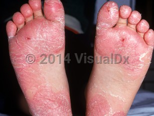 Clinical image of Juvenile plantar dermatosis - imageId=1091062. Click to open in gallery.  caption: 'Extensive scaly pink plaques on the soles and plantar aspects of the toes.'
