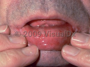 Clinical image of Mucous membrane pemphigoid - imageId=109411. Click to open in gallery.  caption: 'Erosions on the labial mucosa.'