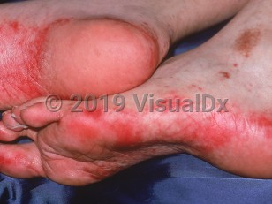 Clinical image of Acral erythema