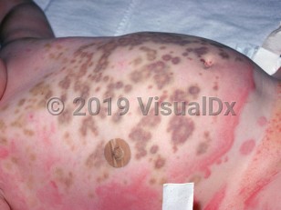 Clinical image of Serum sickness-like reaction - imageId=1102435. Click to open in gallery.  caption: 'Widespread urticarial and ecchymotic papules and plaques on the trunk, developing secondary to cefaclor.'