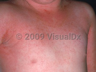 Clinical image of Erythroderma