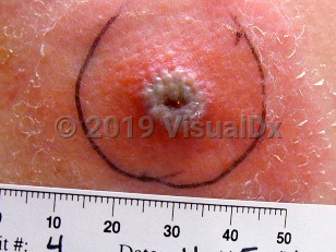Clinical image of Vaccinia vaccination normal reaction - imageId=1106891. Click to open in gallery.  caption: 'An erythematous papule with a central crusted grayish pustule and surrounding erythema.'