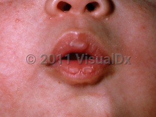 Clinical image of Sucking callus/blister