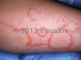Clinical image of Erythema marginatum - imageId=1120099. Click to open in gallery.  caption: 'A close-up of annular and gyrate erythematous plaques with faint surrounding pink-orange patches.'