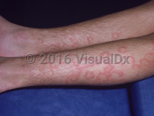 Clinical image of Rheumatic fever