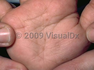 Clinical image of Acropustulosis of infancy - imageId=112054. Click to open in gallery.  caption: 'Scant thin crusts and light brown macules on the palm.'