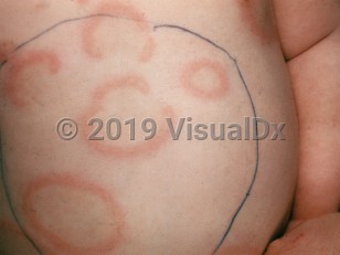 Clinical image of Annular erythema of infancy - imageId=1129588. Click to open in gallery.  caption: 'Arcuate and annular erythematous plaques on the abdomen.'