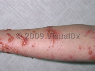 Clinical image of Poison ivy, oak, sumac dermatitis - imageId=113052. Click to open in gallery.  caption: 'Vesicular, erythematous plaques, some linear, and scattered vesicles on the arm.'