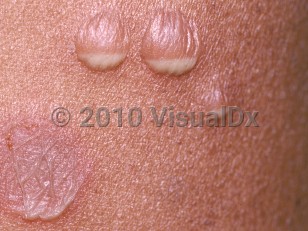 Clinical image of Subcorneal pustular dermatosis
