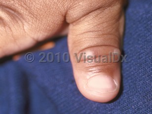 Clinical image of Hand, foot, and mouth disease