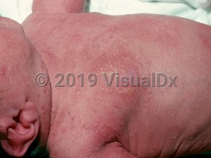 Clinical image of Erythema toxicum neonatorum - imageId=1149248. Click to open in gallery.  caption: 'Multiple erythematous papules and pustules and background erythema on the face, neck, and torso.'
