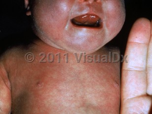 Clinical image of Bronze baby syndrome