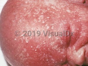 Clinical image of Leiner disease - imageId=1167751. Click to open in gallery.  caption: 'Diffuse erythema and overlying flaky scale on the face and ear.'