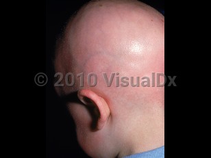 Clinical image of Keratosis follicularis spinulosa decalvans - imageId=1169189. Click to open in gallery.  caption: 'Diffuse scarring alopecia of the scalp with patchy erythema of the scalp, ear, and cheek.'