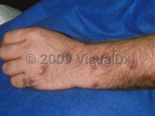 Clinical image of Sporotrichosis